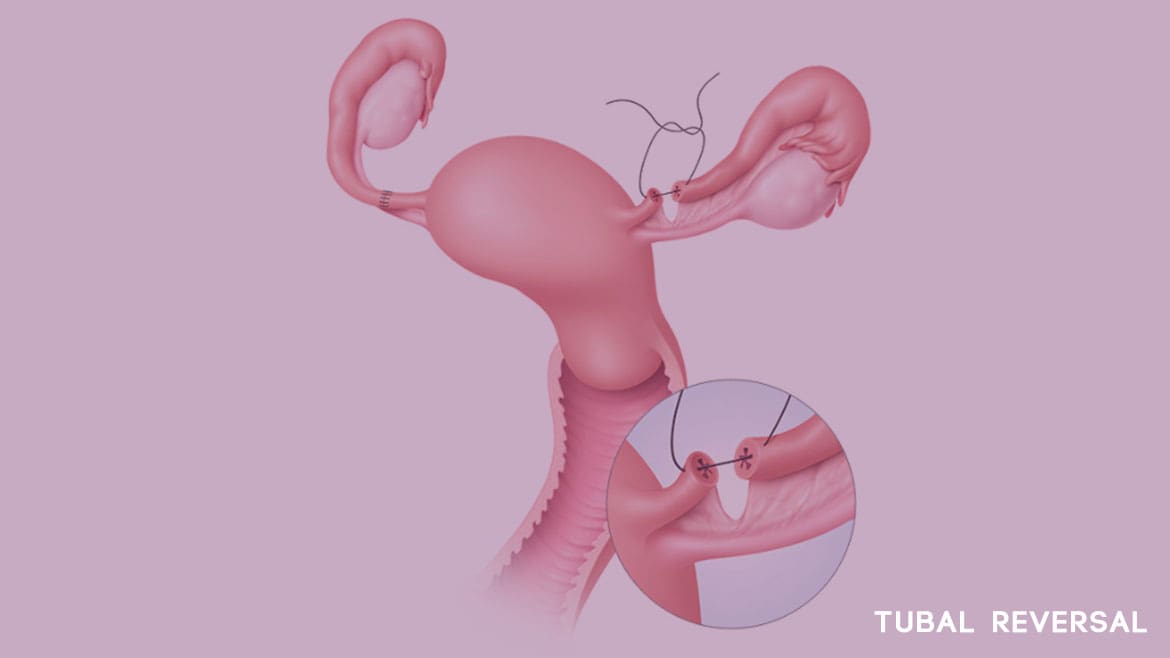 Tubal ligation